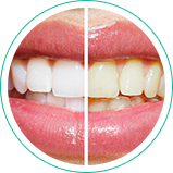 Ananda Odontologia - Clareamento Dental