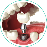 Ananda Odontologia - Implante Dentário